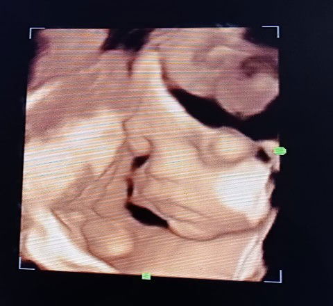 Usia 28 weeks ada kah yang sama dg sy sering kenceng??
USG 4D kemarin Alhamdulillah bayi sehat🤲🤲