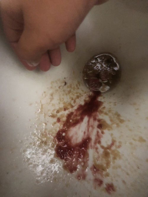 อ้วกเป็นเลือด