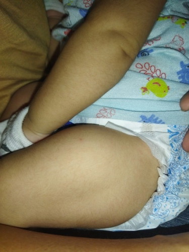 Tanong ko lang po ano mabisang remedy sa pamamaga ng bakuna ni baby sa paa