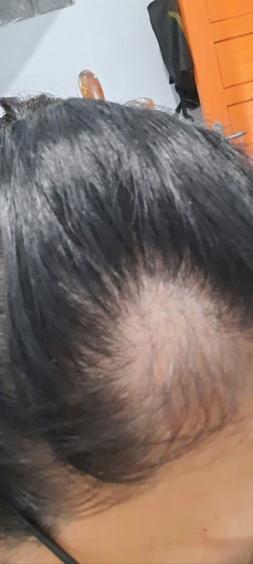 4 bulan pasca lahiran rambut rontok parah