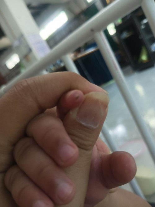 นิ้วน้องเป็นหนอง