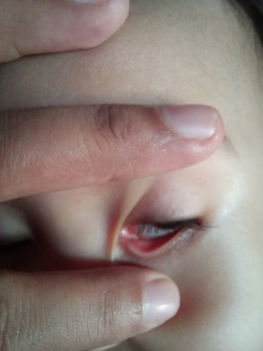 Ada yang pernah ngalamin gini gak bund, dimata bayi ada kayak gumpalan lemak.