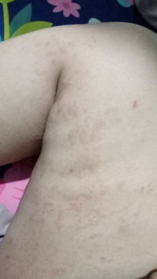 Gatal" setelah hampir 2 bulan melahirkan