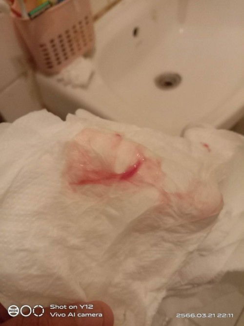 ตรวจปากมดลแบบนี้เรียกเบือดปกติไหมไม่เคยเป็นค่ะแบบเช็ดไม่หมดตอบๆหน่อยนะคะแม่ๆทุกคยหนุประสบการณ์ไม่มาก