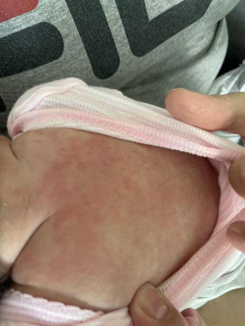 Rashes on one week old