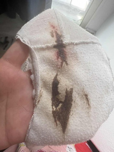 Bleeding 15 minggu