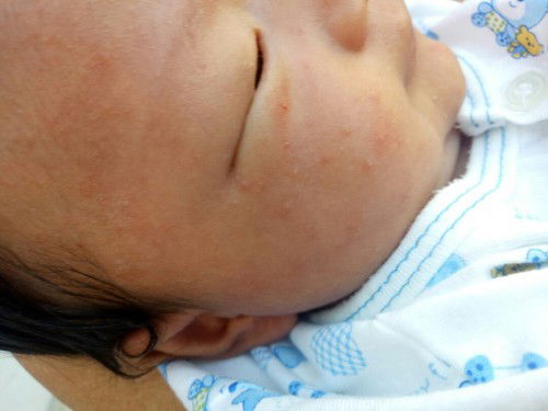 ผดผื่นแดง