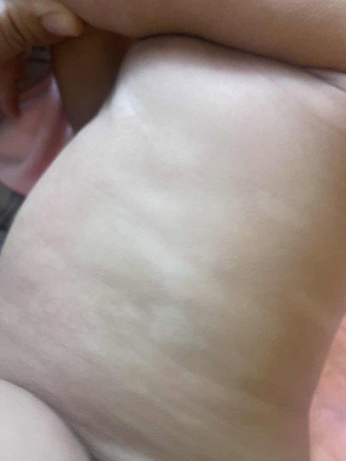 Bercak putih di badan bayi