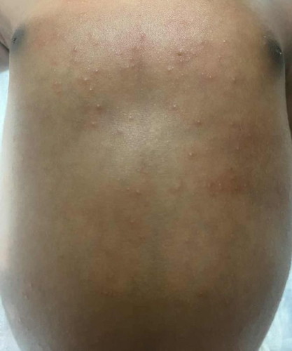 Baby rash newborn