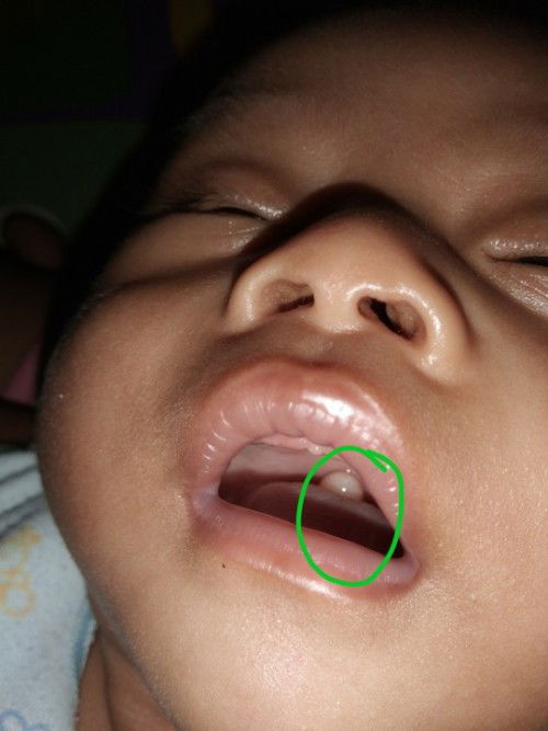 Bayi 3bulan ada benjolan di tenggorokan