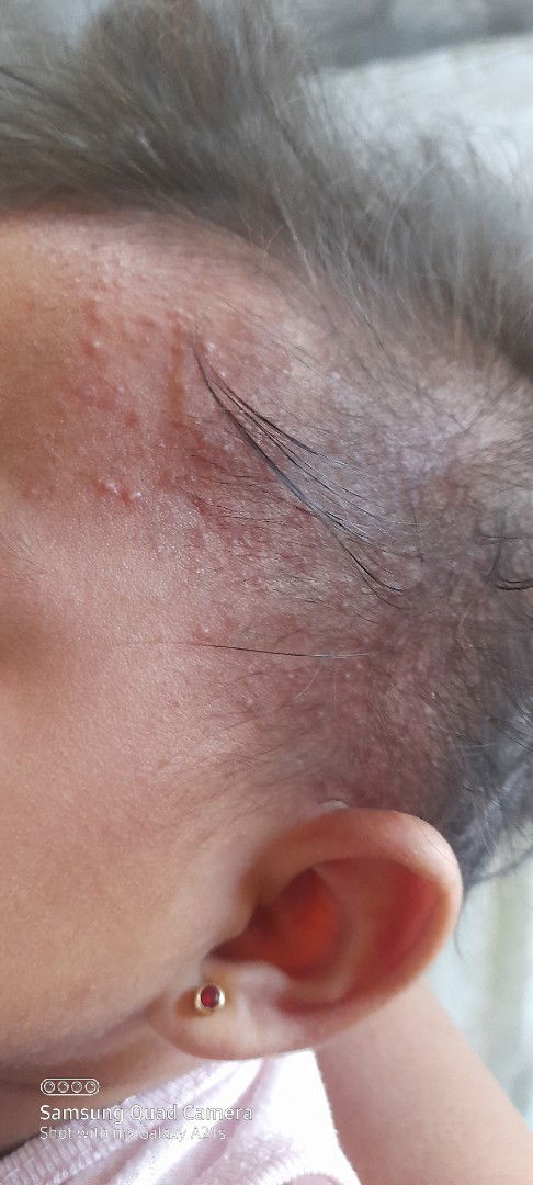 Tigdas po b ito...laging kinakmot ng lo q..at lgi cia naiyak dahil jan