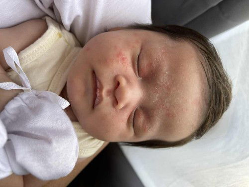 Red bumps or pimples sa face ni baby