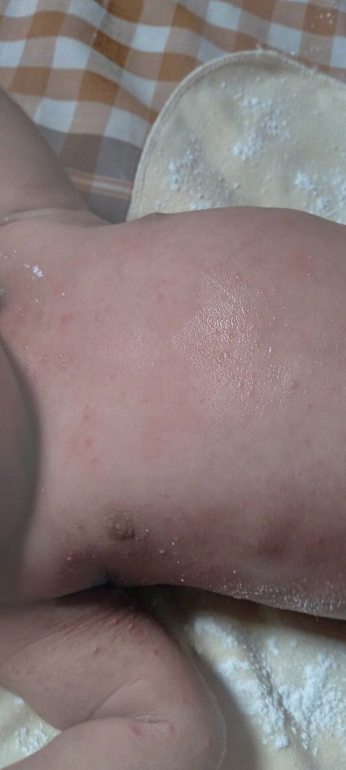 Hai bun,,mau tanya dong obat yang cocok untuk kulit anak saya apa ya bun,kasian gatal2 trus merah gt