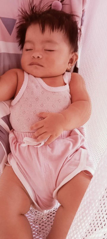 Totol coklat di wajah bayi