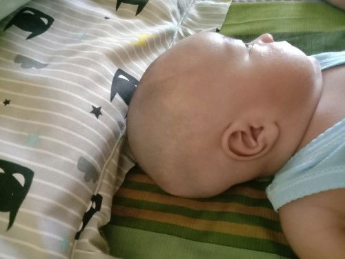 Kepala bayi tidak rata