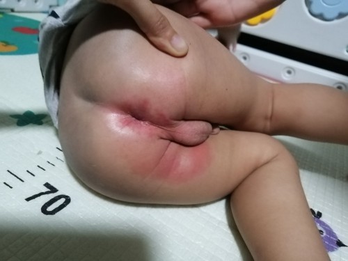 Nagtatae at rashes kay baby