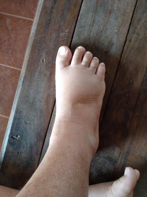 มือเท้าบวมผิดปกติมั้ย