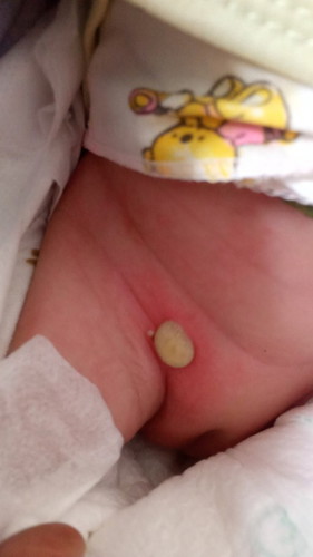 Bun, ada yg pernah anak nya ngalamin kek anak aku. Timbul bintik merah isi nana