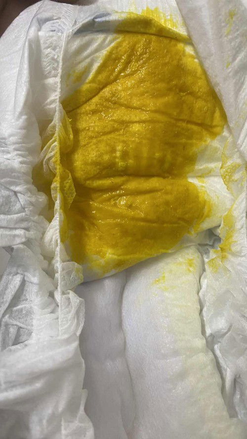 Baby demam suhu turun naik