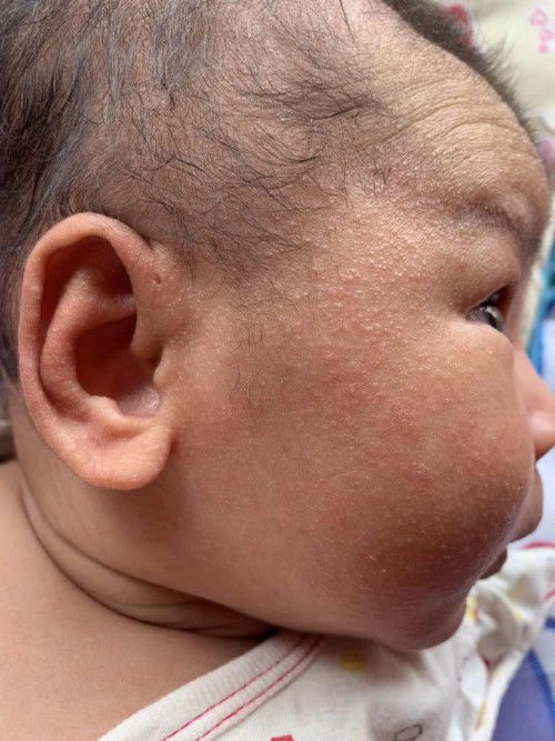 น้องเป็นผื่นแบบนี้ ใช้อะไรทาค่ะ