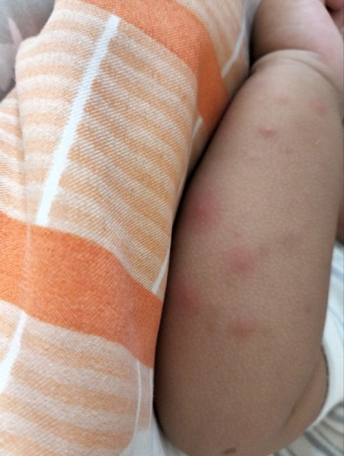 Bentol bentol pada bayi