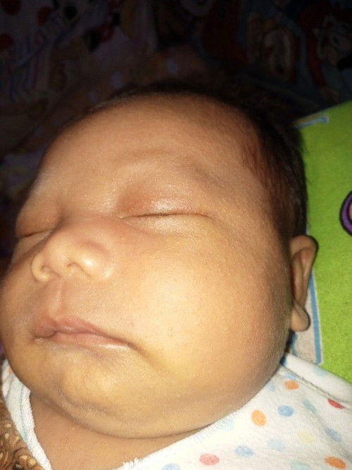 Muka bayi bintik bintik