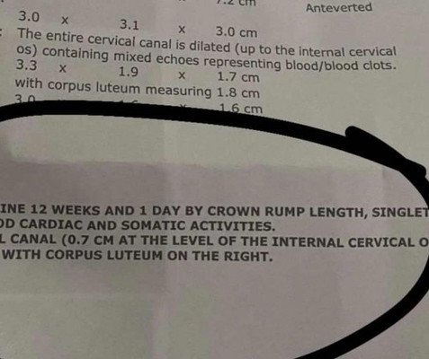 dillutaed cervix