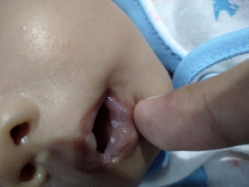 Bercak putih seperti ASI