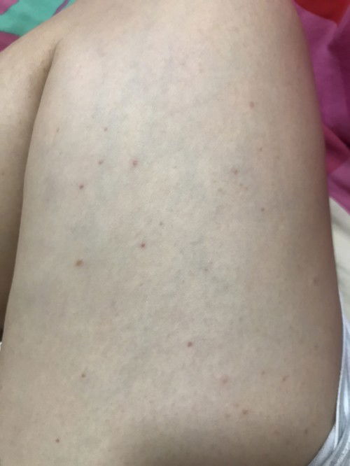 คันผื่นแดงขึ้น😆