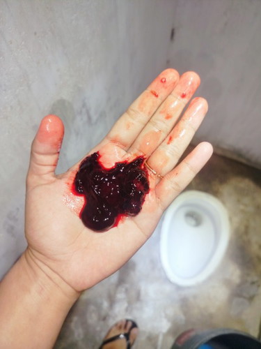 Darah ketul setelah period berpanjangan