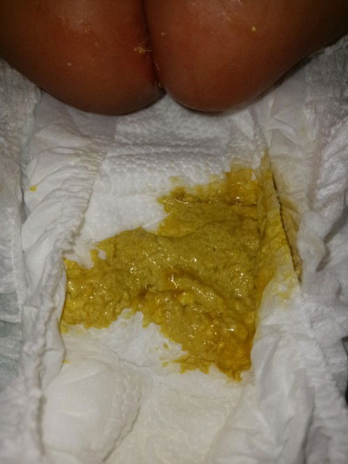 ลูกถ่ายแบบนี้ถือว่าปกติไหมคะ ลูก2เดือน24วันคะ