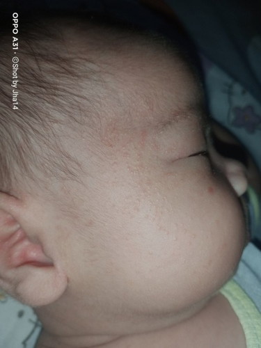 normal lang po yung ganito sa muka at tenga ni baby? ..dahil lang po ba ito sa pawis?