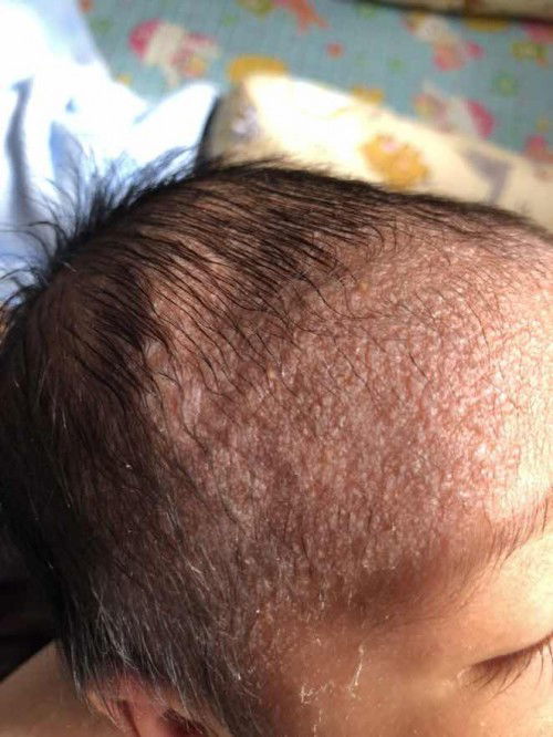 Kulit kepala bayi?