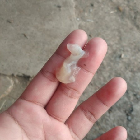 37วีค2วัน เริ่มปวดแต่ปวดไม่มาก