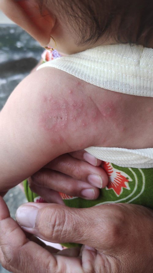 Ada kah di sini yg baby nya pernah kena herpes?