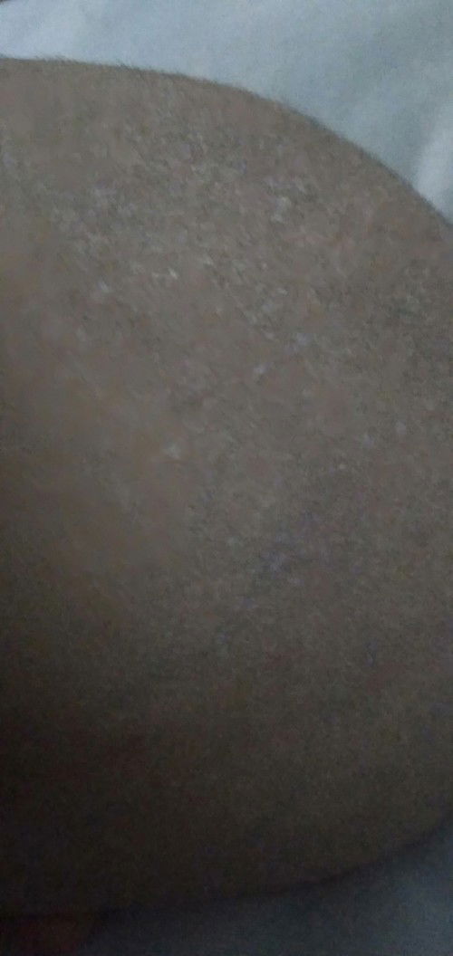 Kepala Bayi bruntusan