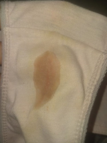 Hi mommies normal ba to 6weeks preggy ako nag sspoting ulit pinapatake ako ng OB ko Ng duphaston