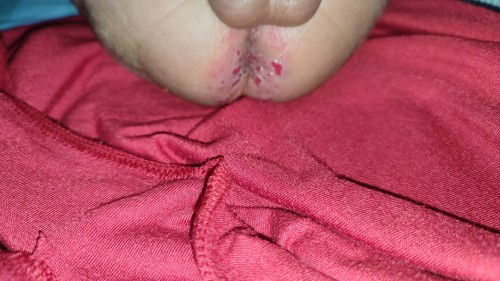 Bun ada yg anaknya pernah gini ga pantatnya? Aku udah konsul kebidan cuman dikasih salep