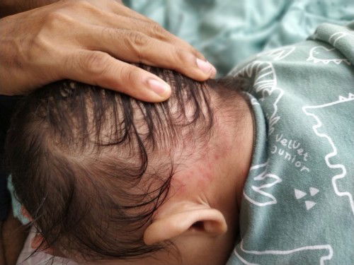 Bintik merah di kepala bayi