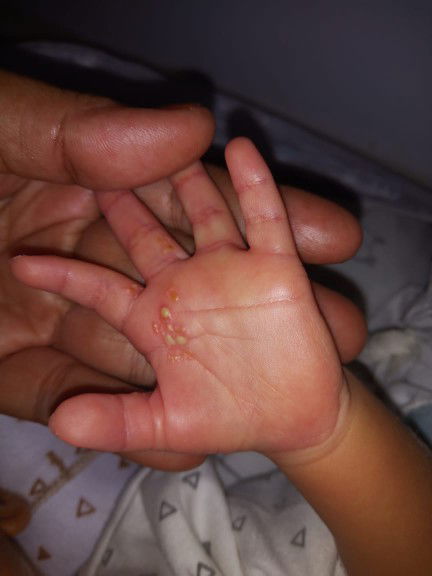 Tangan baby 15 hari bernanah
