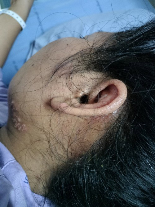 เป็นงูสวัดตอนอายุครรภ์35วีค อันตรายต่อน้องในท้องมั้ยคะ