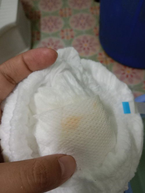 ฉี่น้อย ฉี่เป็นสีเข้ม อันตรายไหม