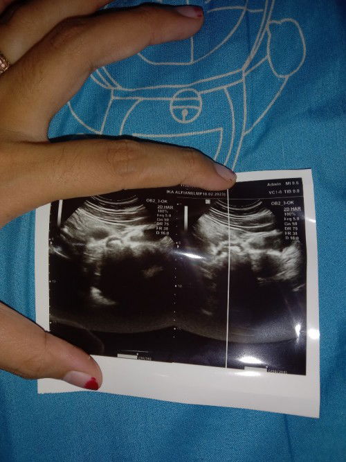 Bun kmren aku baru usg, setelah mengetahui aku garis 2.. tpi kata dokternya belm kliatan kantung jan