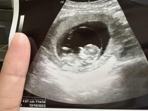 อยากเห็นน้องของแม่ๆ11-12 w ค่ะ