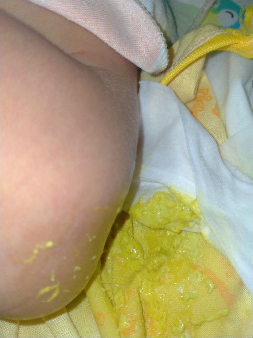 Bab bayi newborn berair ada ampas