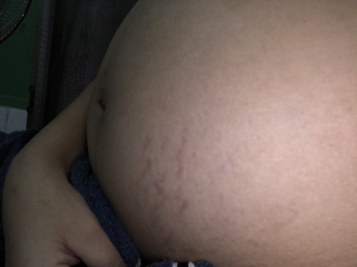 29วีค+3วัน ท้องเริ่มเเตกเเล้วว
