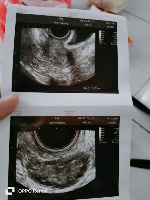 Hai Bun disini ada yang pejuang PCOS berat gak?sama kaya aku,boleh dong Bun sharing gmn