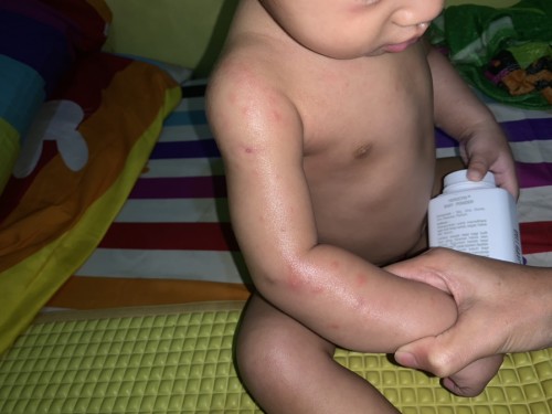 Alergi atau biang keringet
