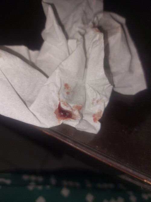 Gumpalan daging & darah di payudara saat menyusui