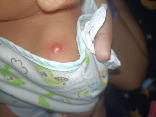 มีตุ่มบวมแดง กดแร้วน่าจะปวด ทำไงดีคะ